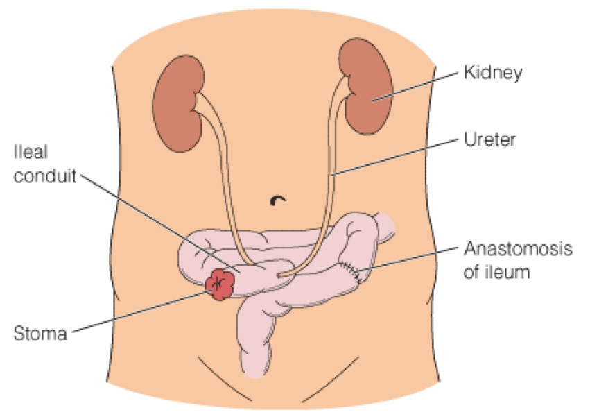 Ileal conduit urinary diversion